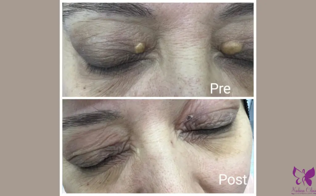 علاج رواسب الكولسترول حول العين في الغردقة