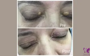 علاج رواسب الكولسترول حول العين في الغردقة