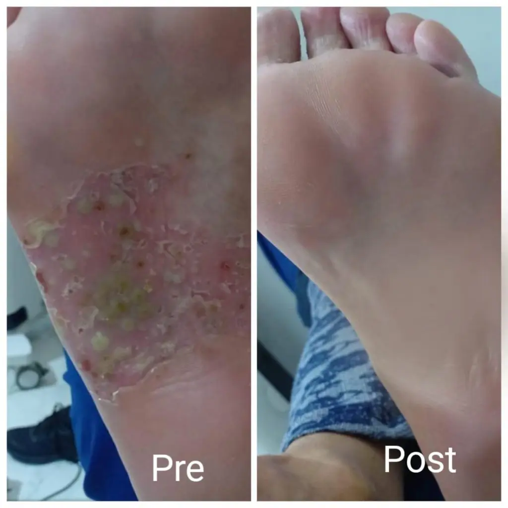 Foot eczema