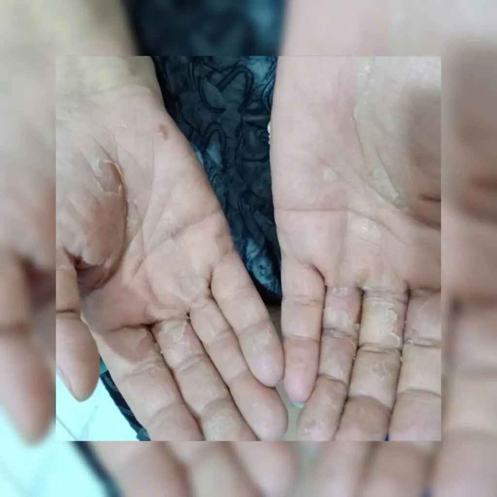 Palm eczema condition