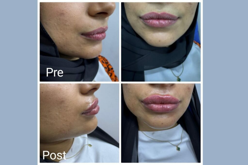 Dermal filler