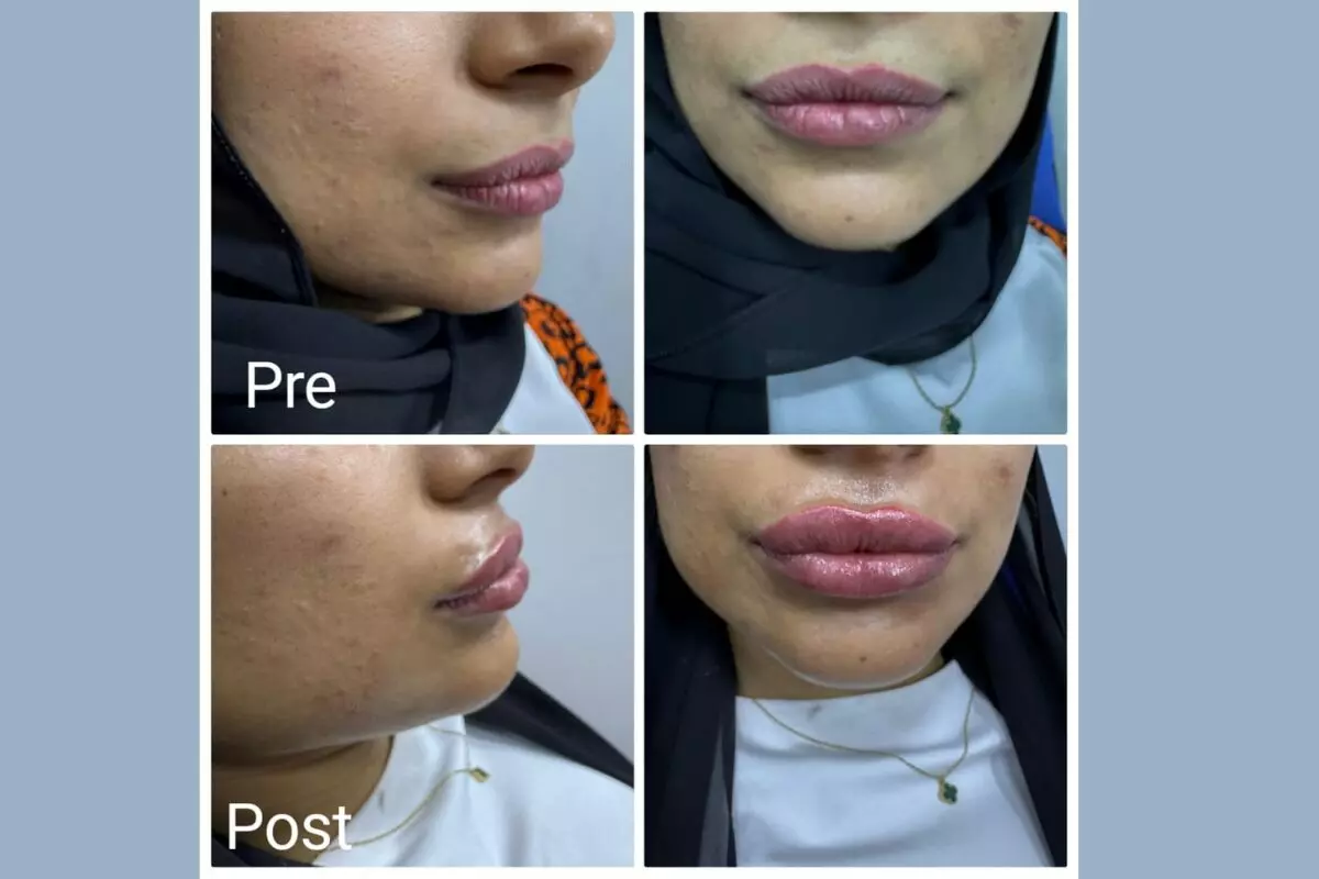 Filler injection