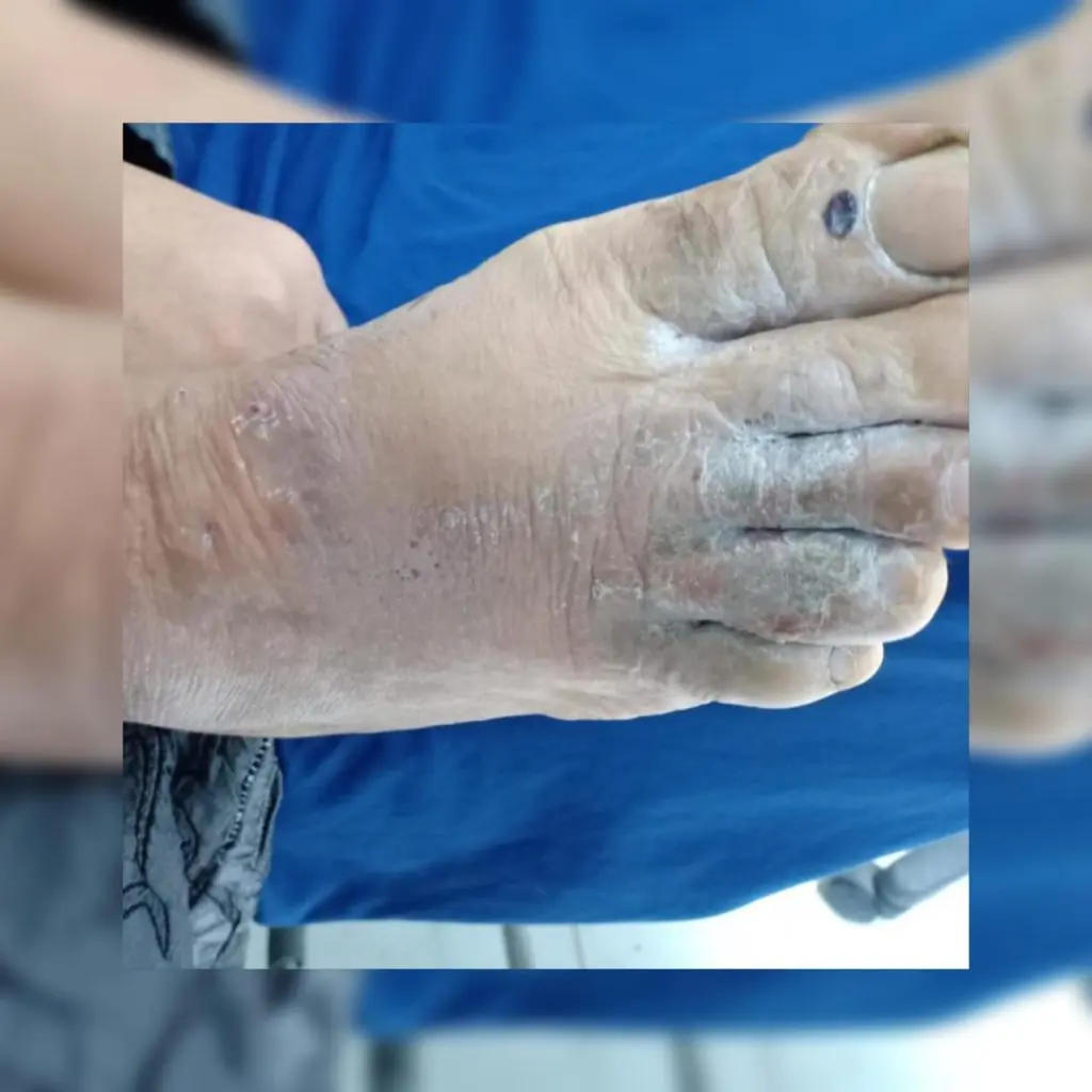 Foot eczema