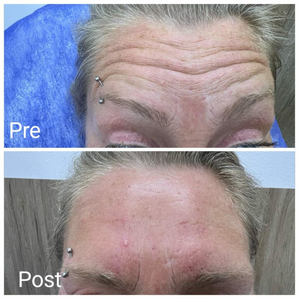 Botox injections treat forehead lines