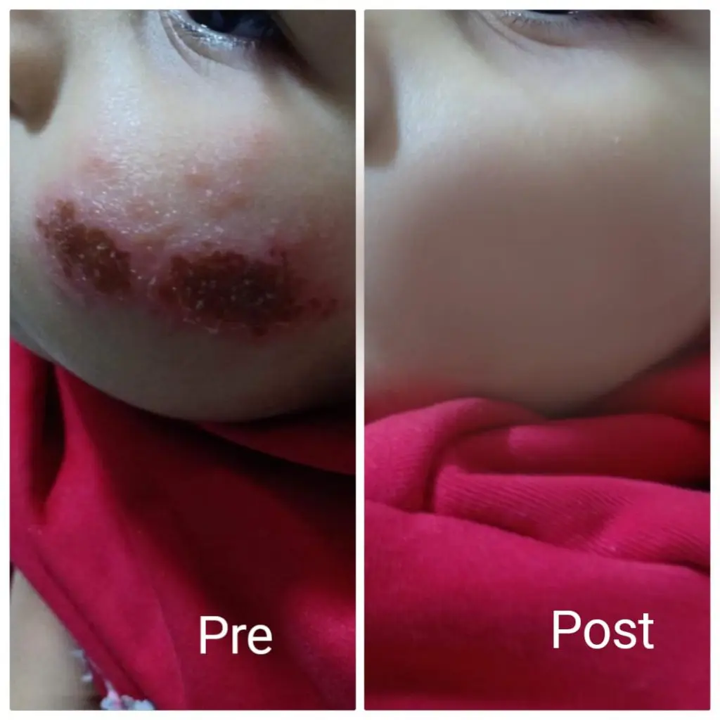 Baby eczema treatment
