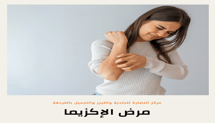 eczema disease