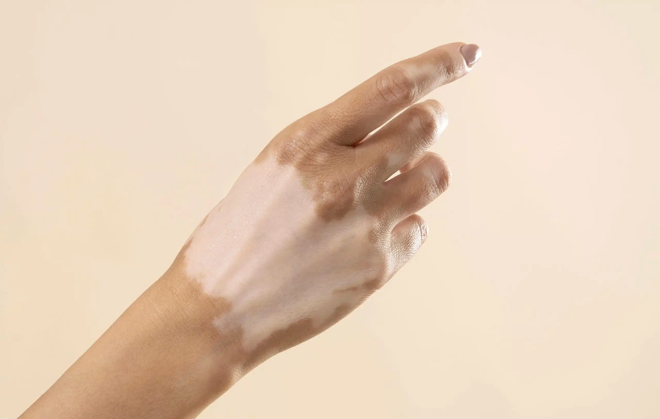 Pictures of Vitiligo