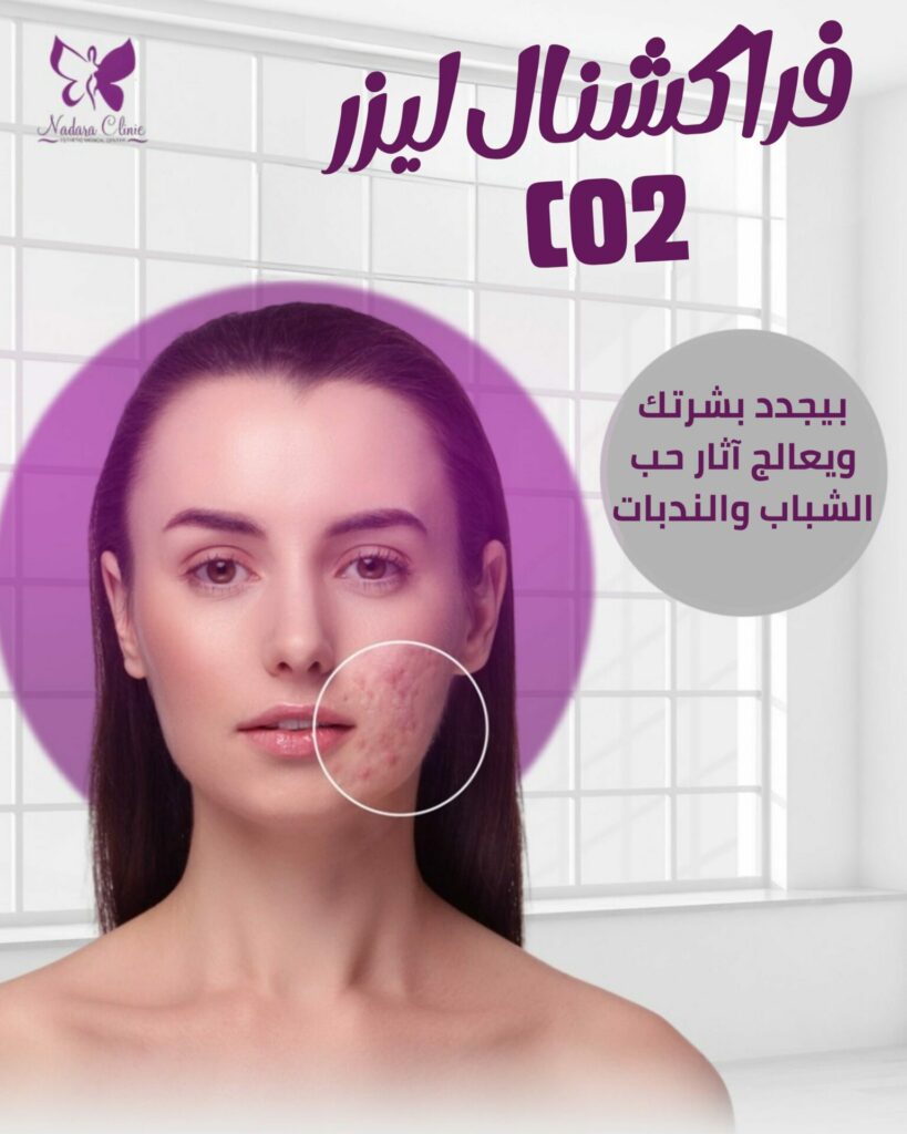 فراكشنال ليزر