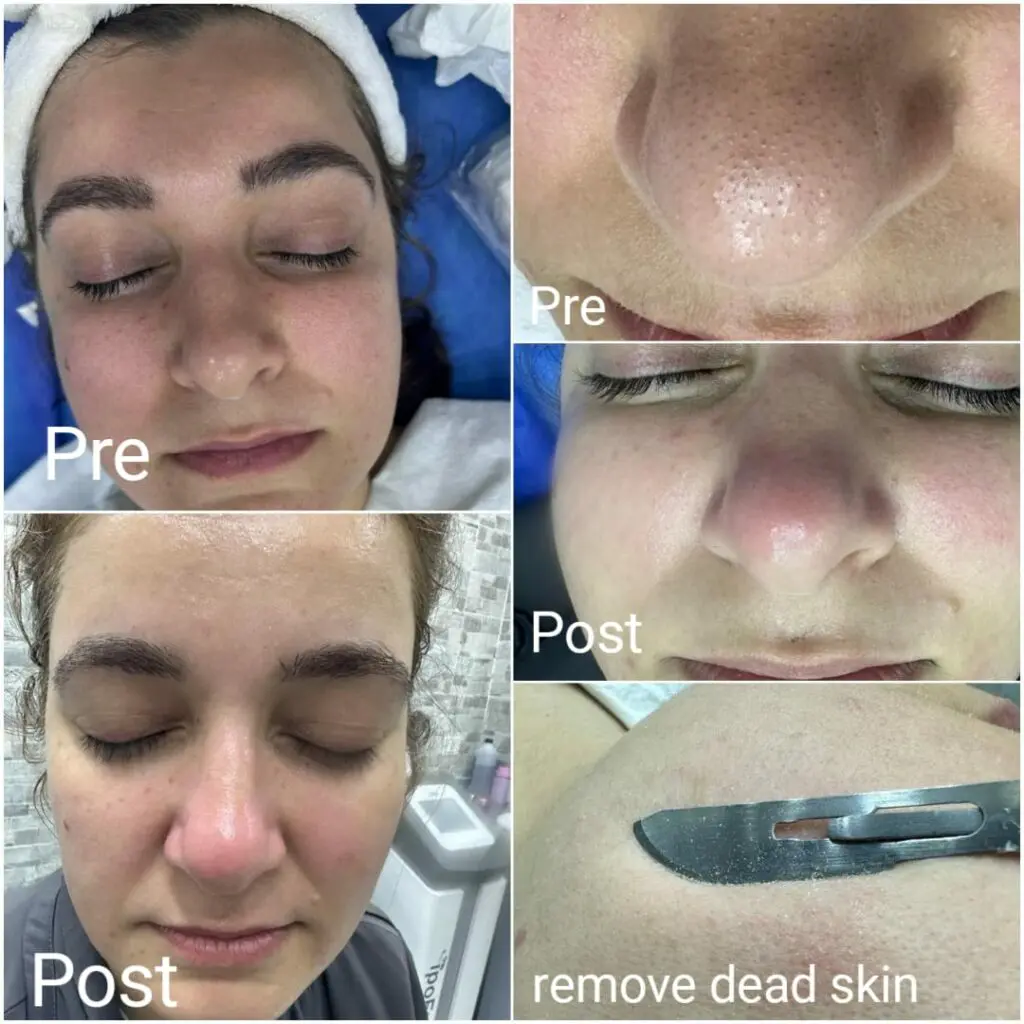 Deep skin cleaning session in Hurghada