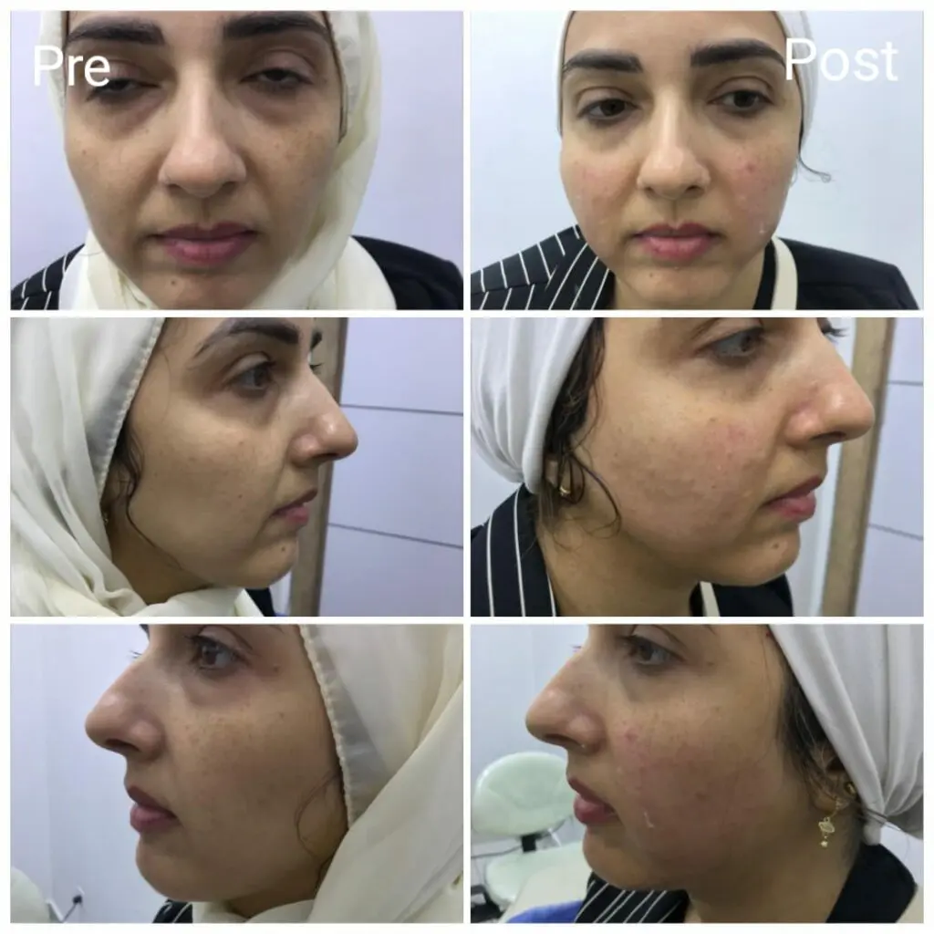 HIFU face lift before and after