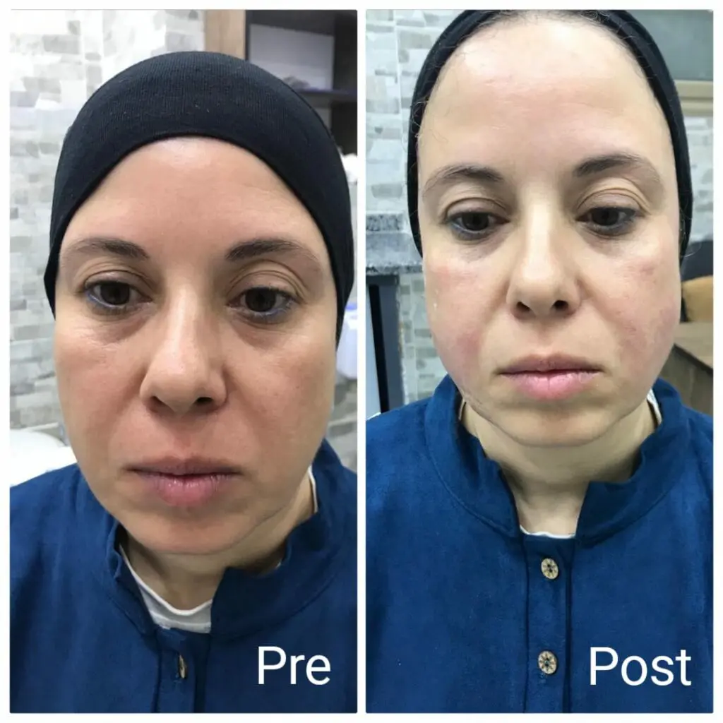 Tightening, freshening and improving facial lines with HIFU