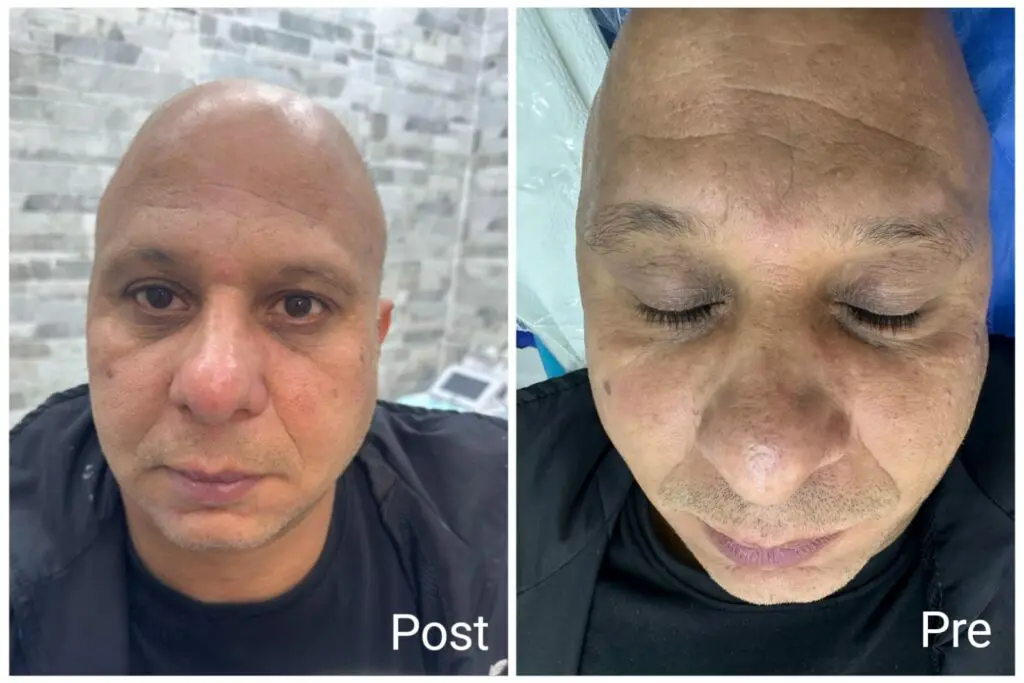 Results of deep skin cleansing before and after