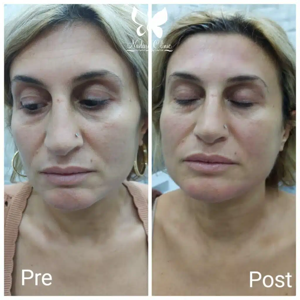 Hifu facelift results in Hurghada