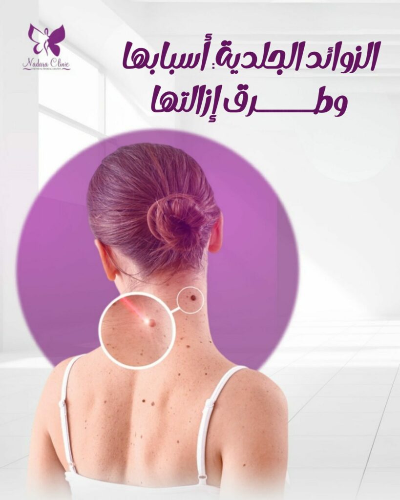 الزوائد الجلدية أسبابها وطرق إزالتها