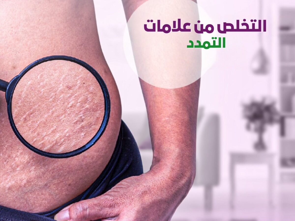 get rid of stretch marks; The most important 6 methods of treatment - Skin  Freshness Center