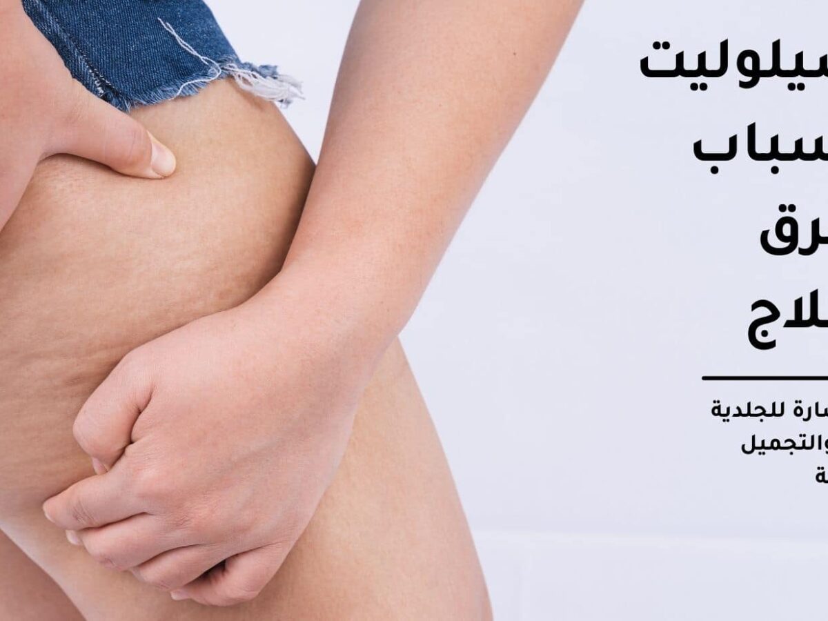 Cellulite, Causes and ways to get rid of it