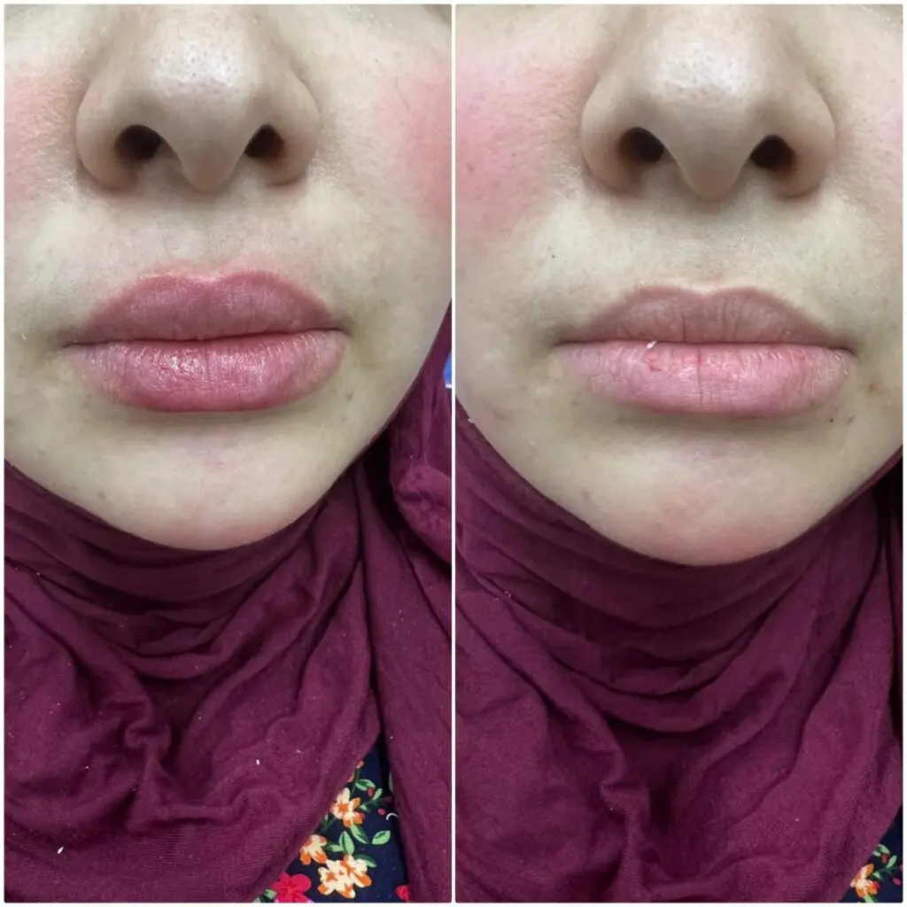 Enlarging and defining the lips with filler