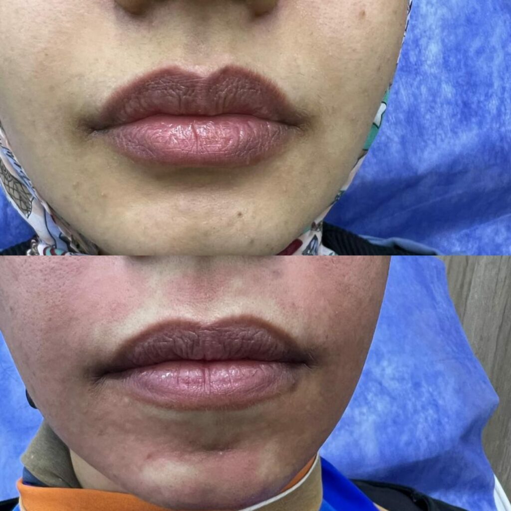 Lip enlargement filler before and after