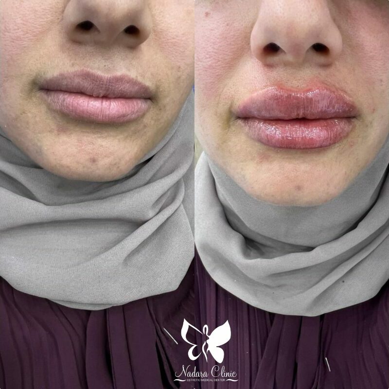 Lip augmentation and definition with fillers - Book now
