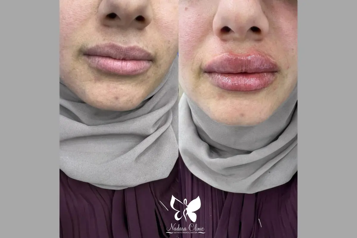 Define and enlarge lips with fillers