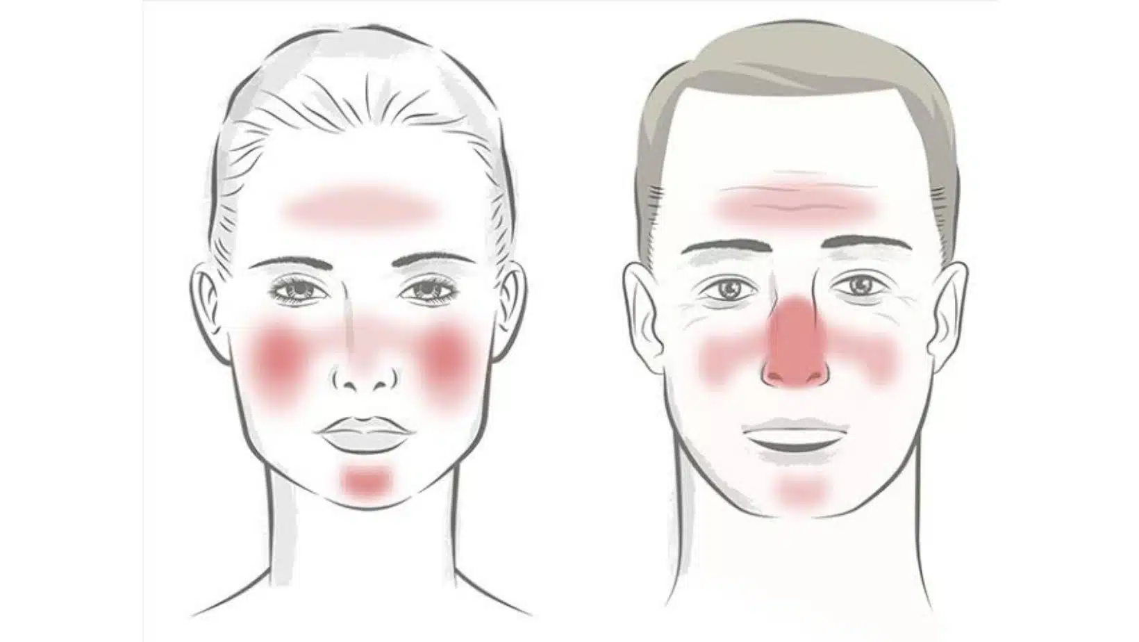 Rosacea disease pictures