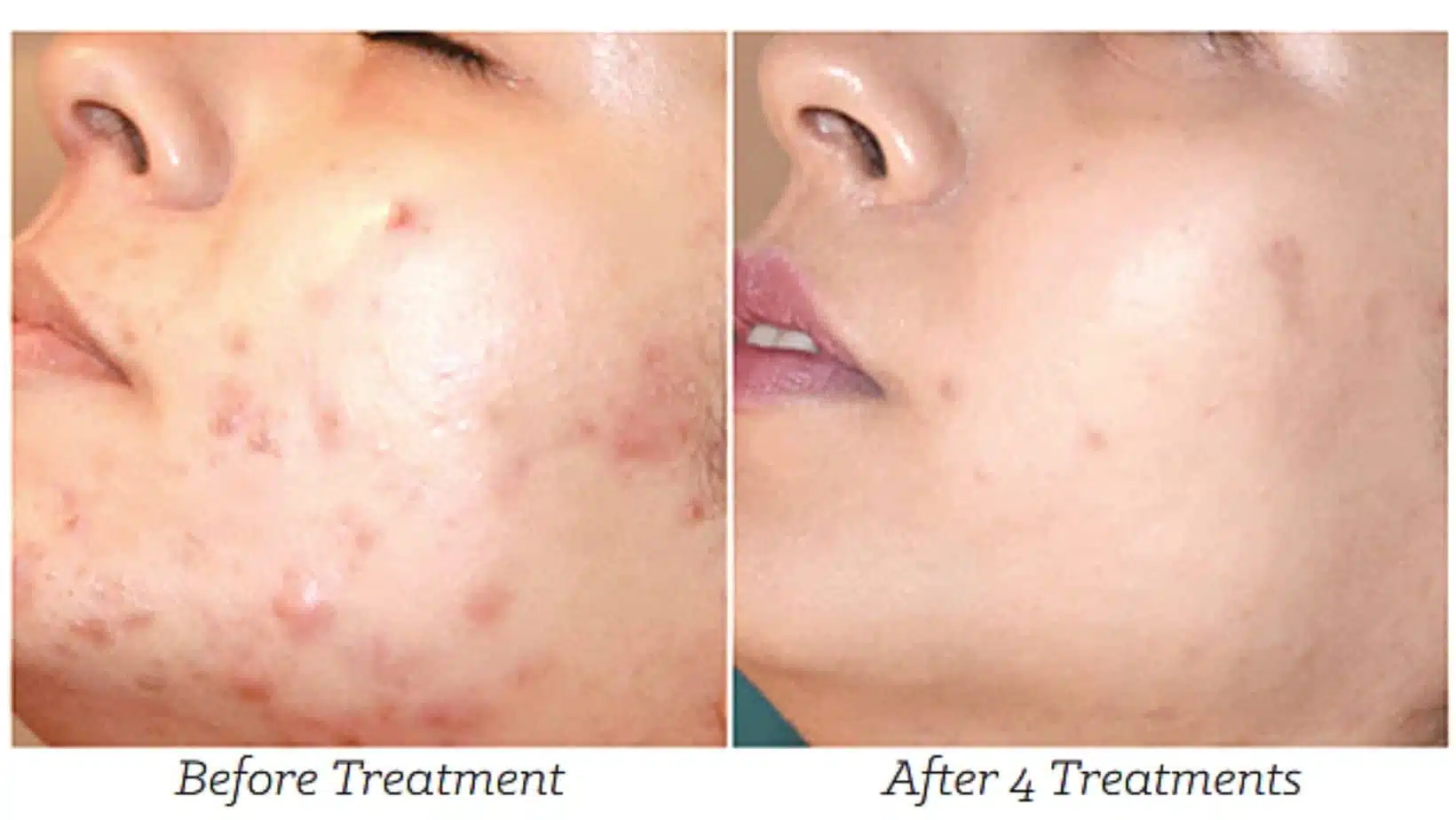 Mesotherapy with Dermapen 
