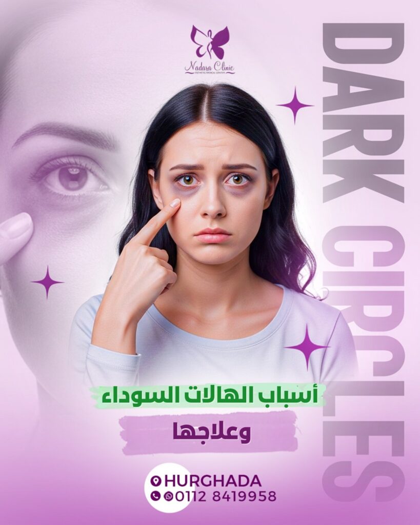 أسباب الهالات السوداء وعلاجها في الغردقة