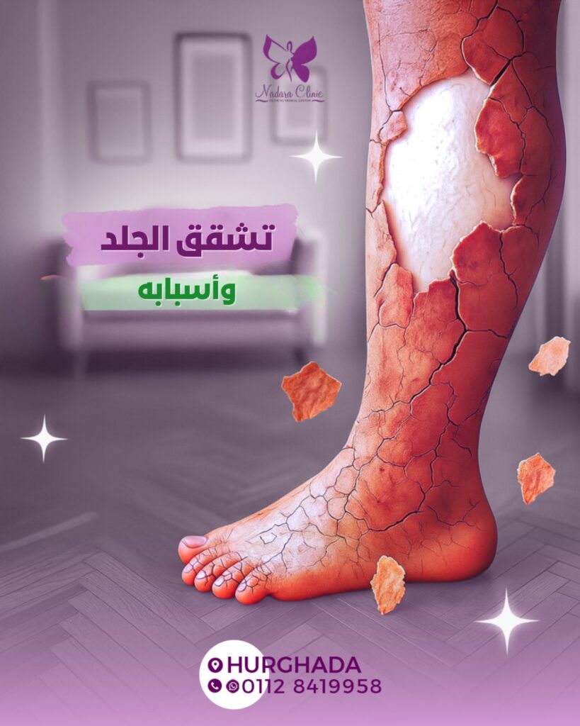 تشقق الجلد وأسبابه في الغردقة