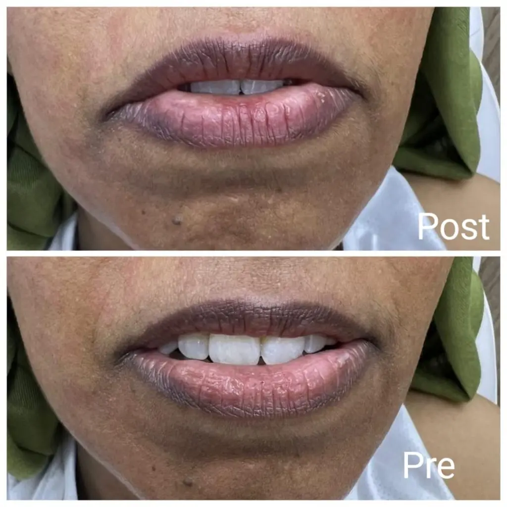 Removing lip pigmentation with laser after a session