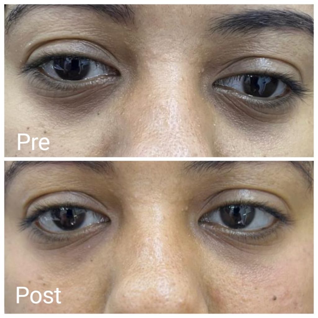 Getting rid of blackness under the eye with fillers