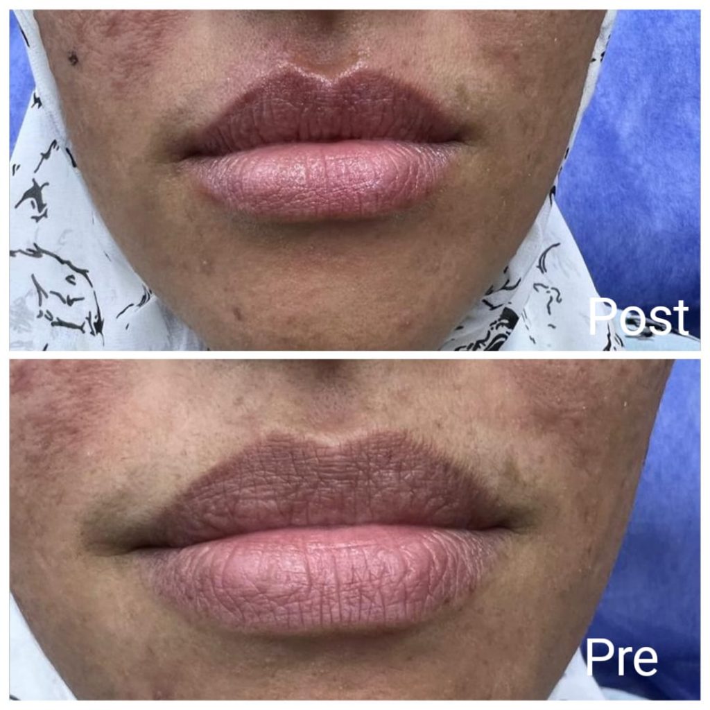 Laser lip augmentation after two sessions