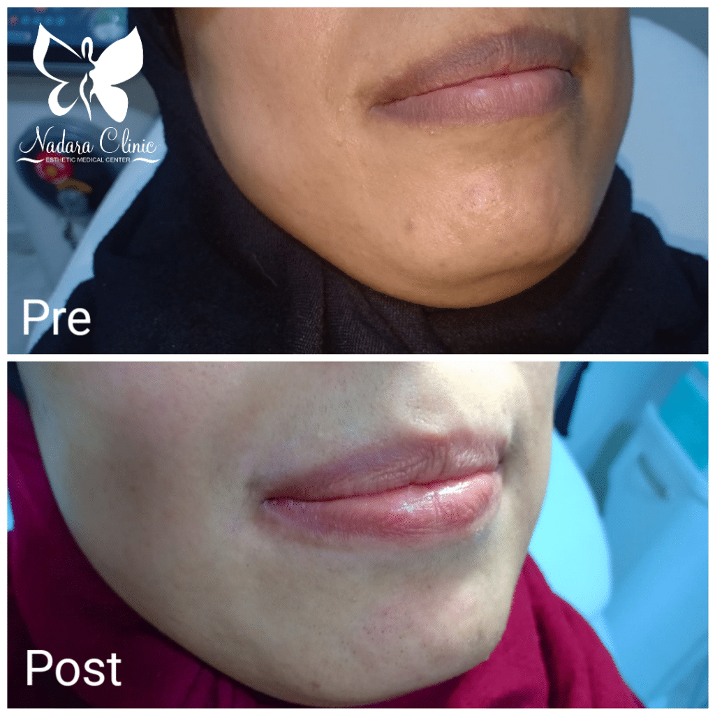 Lips pinking laser in Hurghada