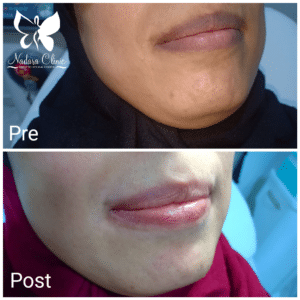 Laser lips supply in Hurghada