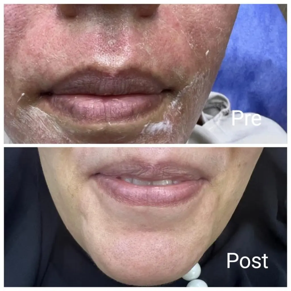 lips pinking laser before and after