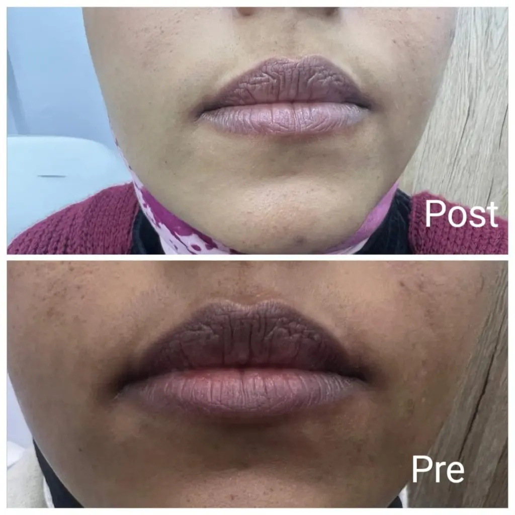 Lips pinking laser