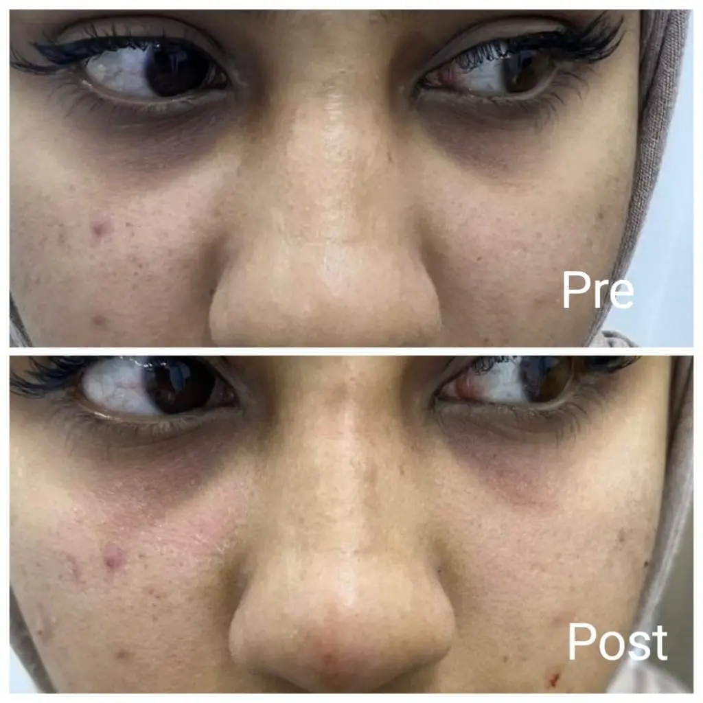 Filler injections to get rid of under-eye circles