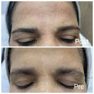 Eyebrow lift with Botox in Hurghada