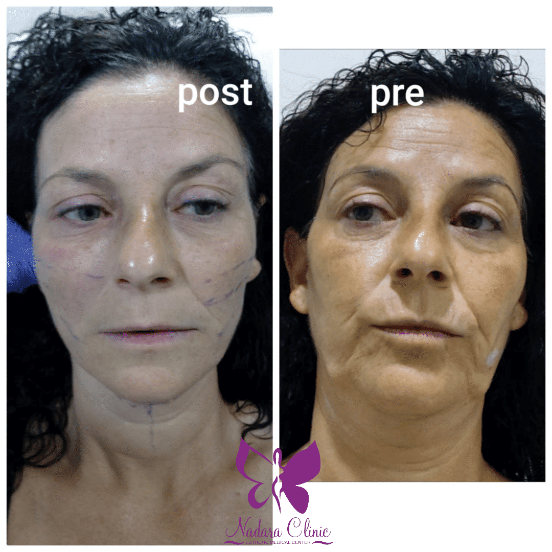 Facelift with cosmetic threads