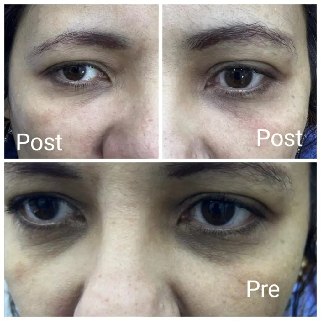 Results of filler injections for under-eye circles
