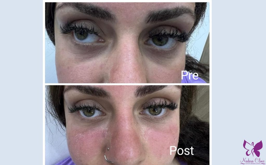 Filler to treat dark circles