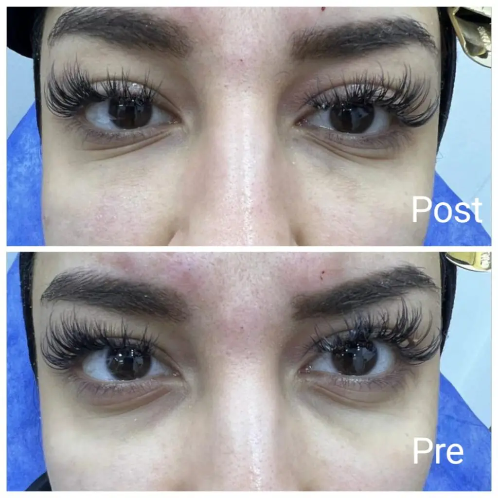 Results before and after injecting fillers under the eyes