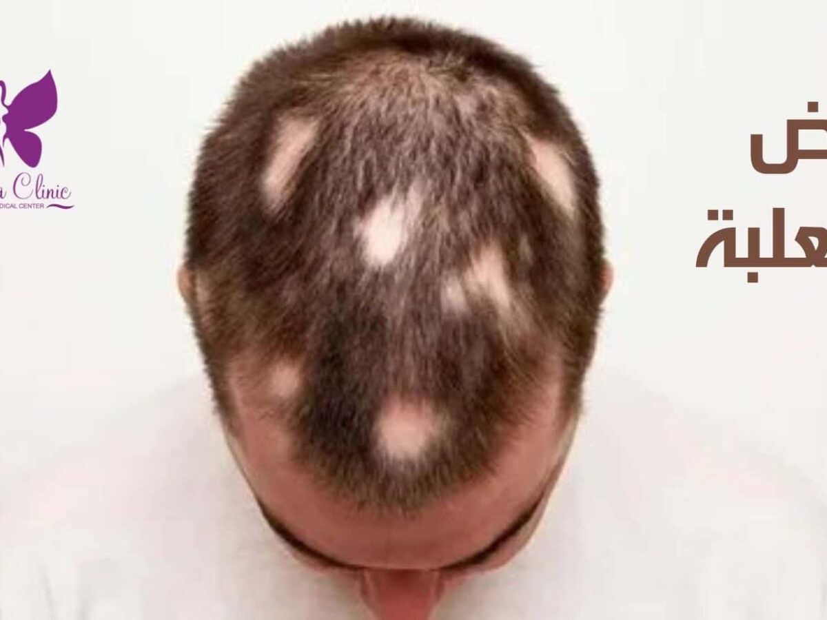 What Exactly Is Alopecia? 5 Facts To Keep You Informed - 21Ninety