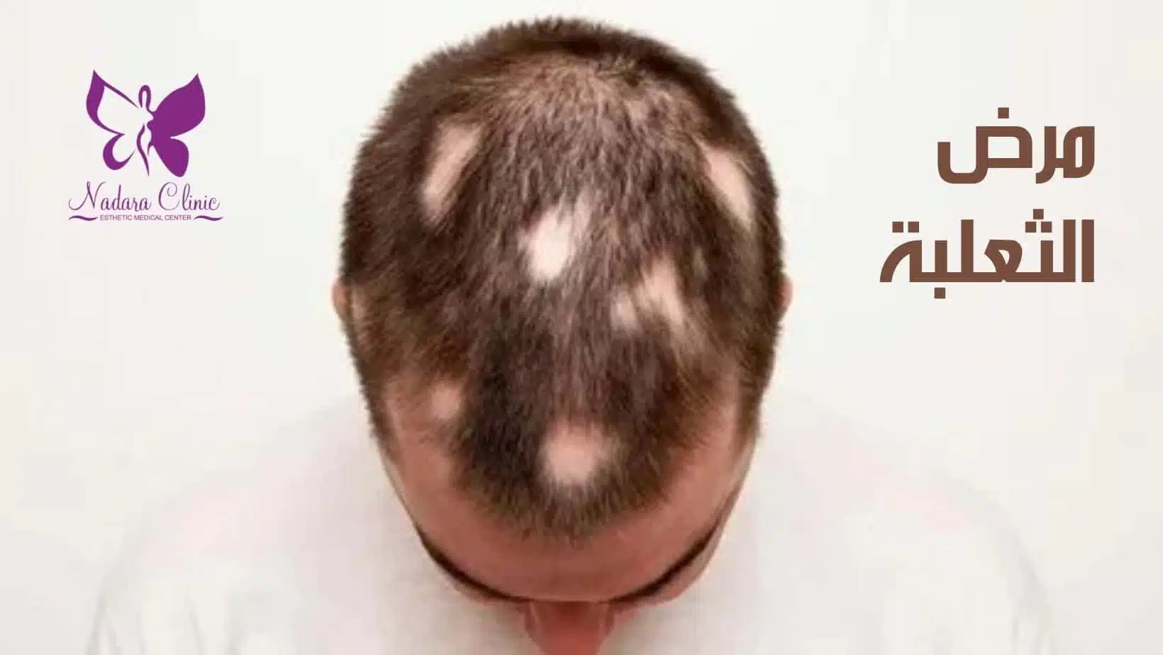 alopecia areata
