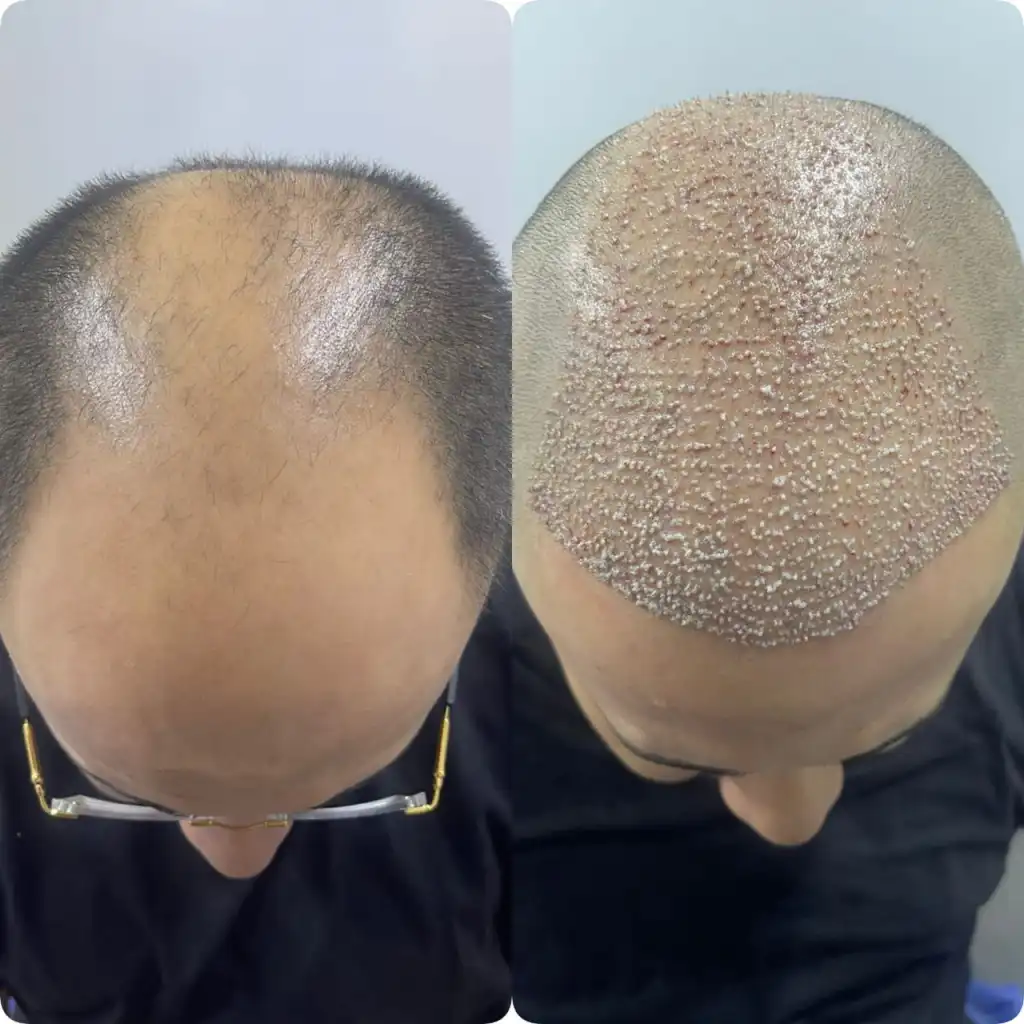 Hair transplant before and after pictures