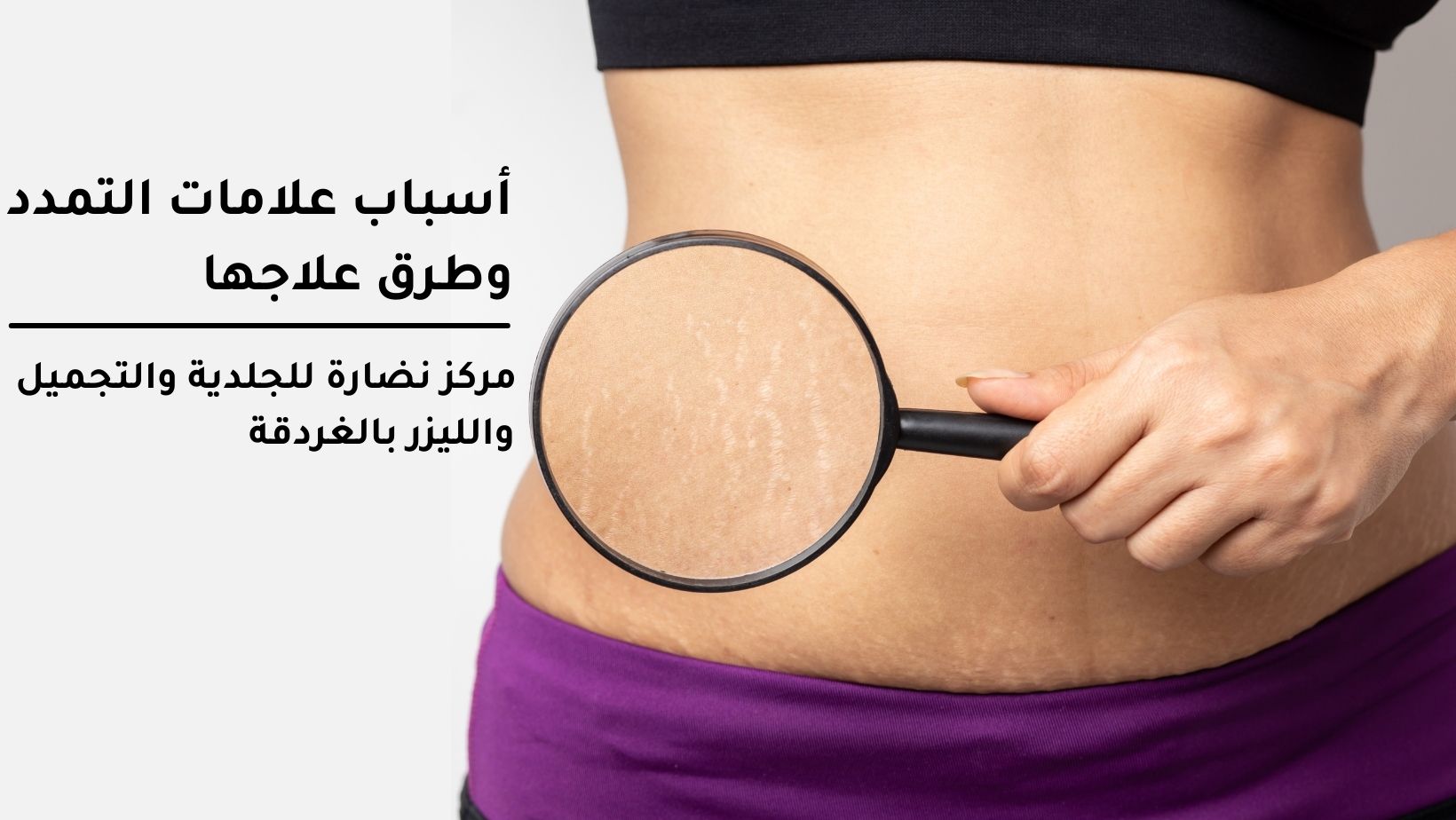 Causes of stretch marks and ways to treat them