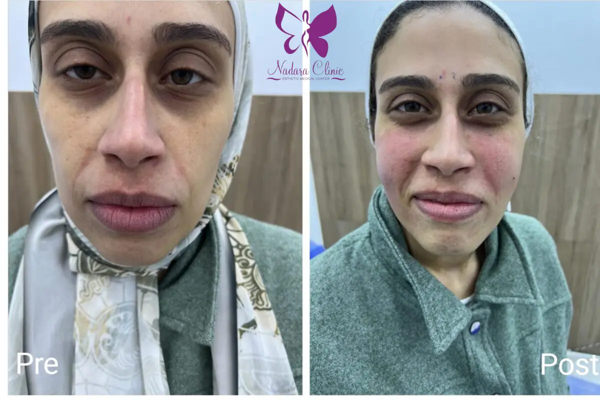 Plasma filler injections for the face in Hurghada