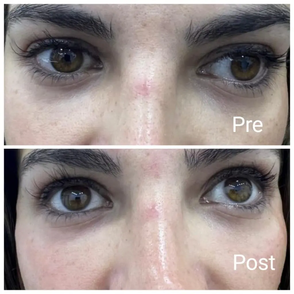 Filler to treat dark circles Nadara clinic for dermatology, laser and