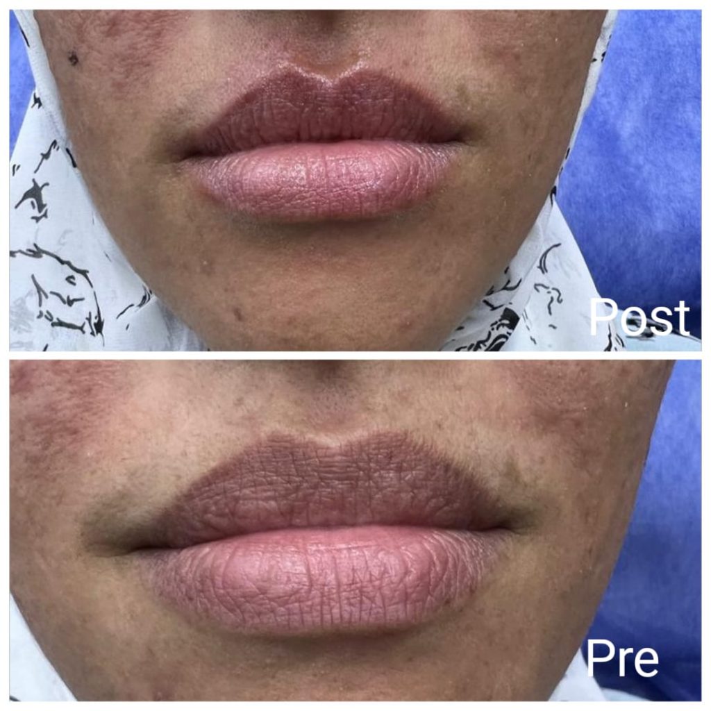 Lips pinking laser book now Nadara Clinic