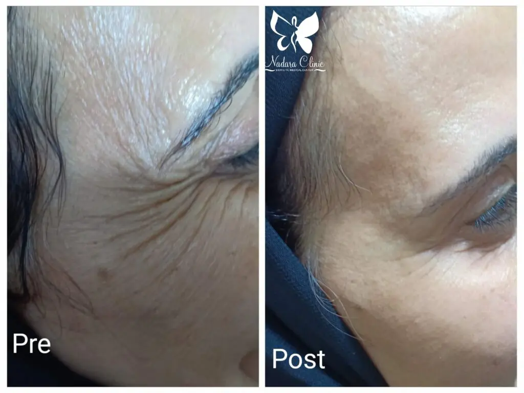Botox injections in Hurghada to treat wrinkles around the eyes