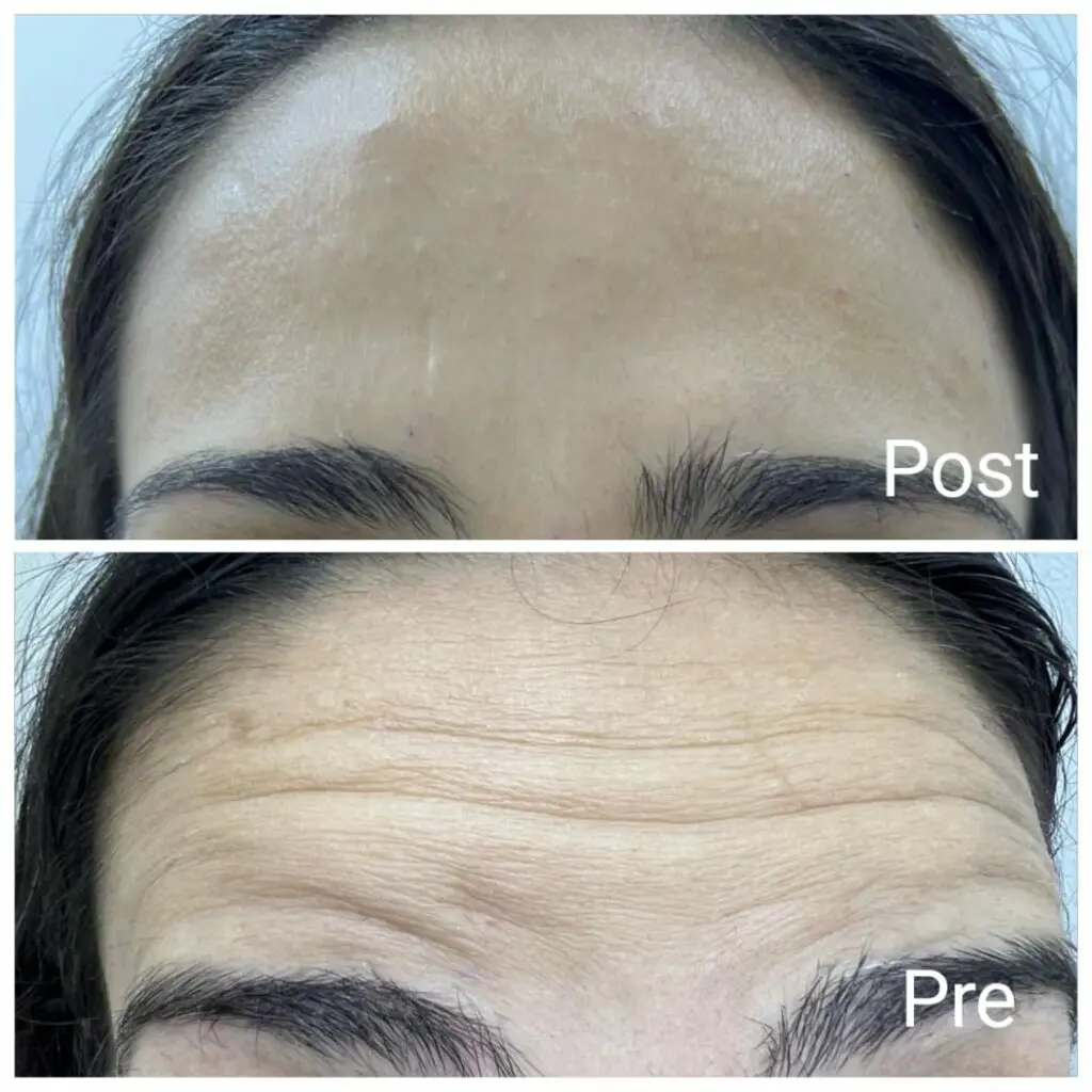 Botox injections for forehead lines